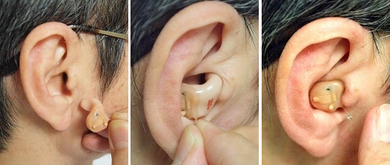 耳穴型補聴器の装用方法